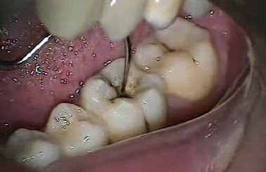 牙齿上的窝沟、窝沟龋、窝沟封闭是怎么回事?